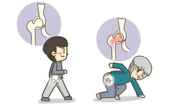 生活中如何保护自己的股骨头？