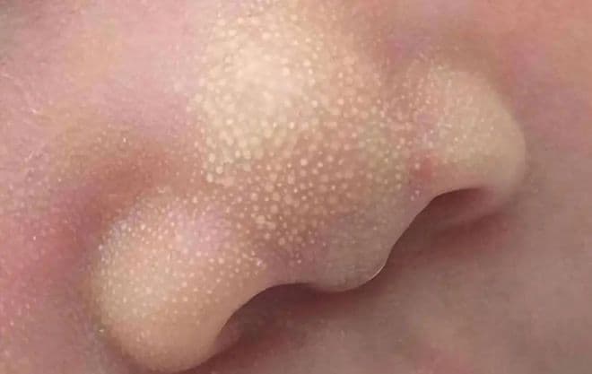 别慌！新生儿这5种【怪现象】根本不是病！别急着去医院