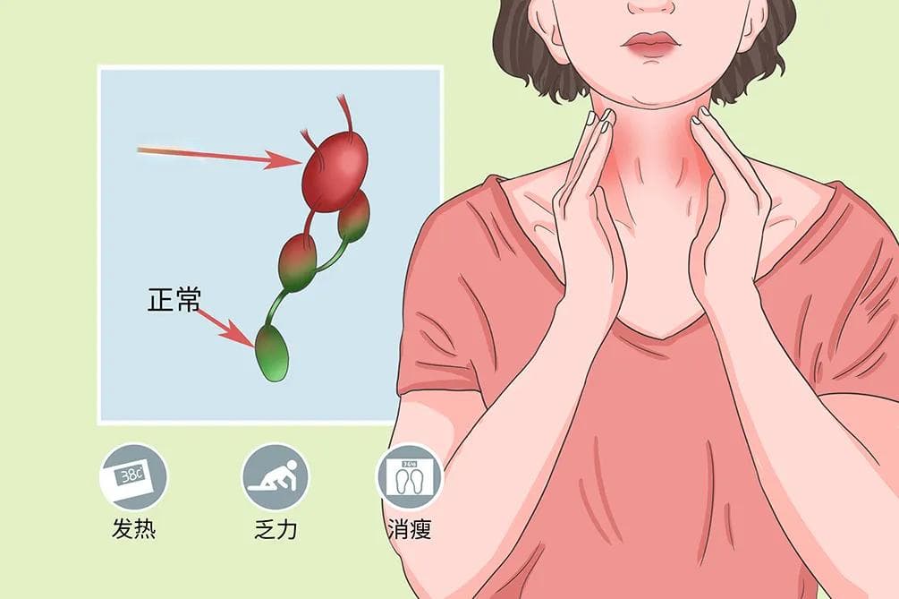 淋巴结肿大治疗方法