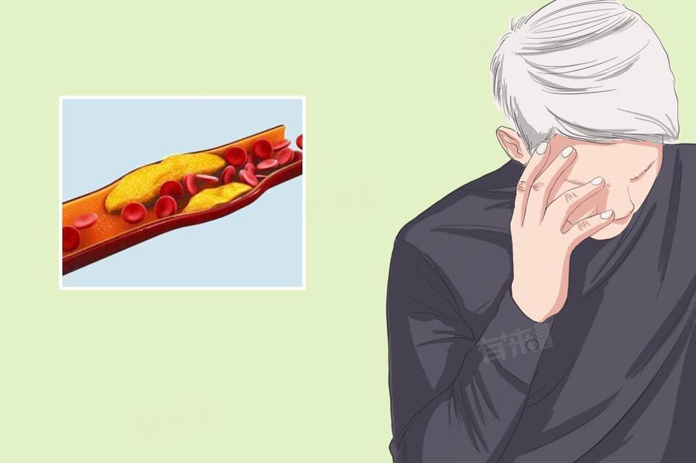 怎么判断自己胆固醇高