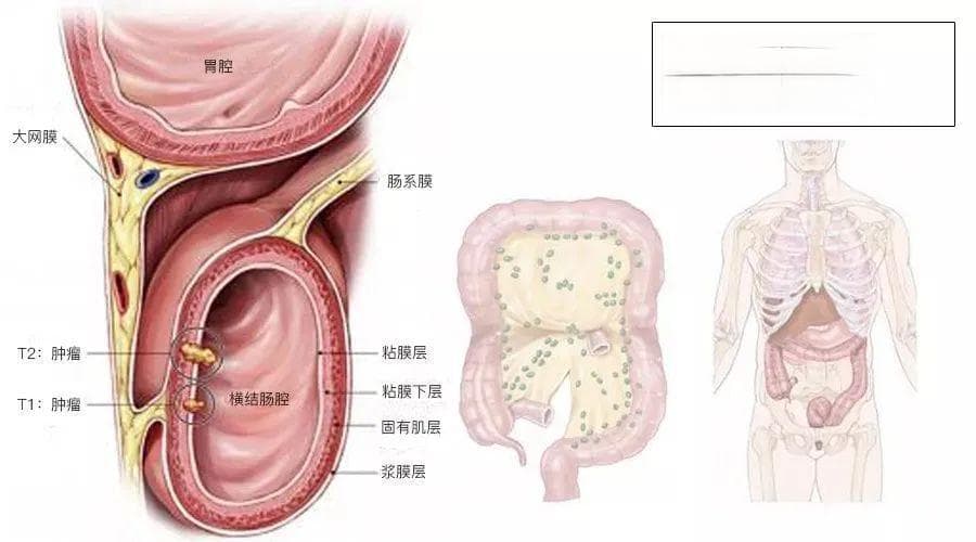 一文了解：结直肠癌TNM分期