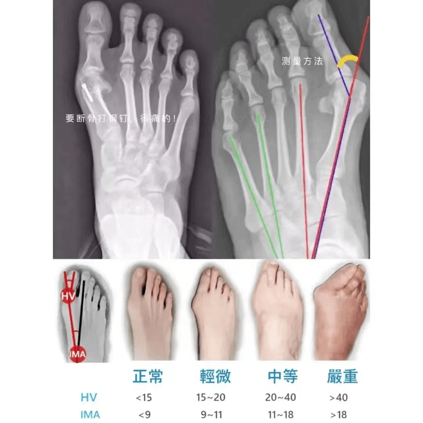 【科普】拇趾外翻，X射线下是怎样的？