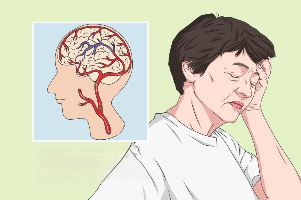 后循环缺血