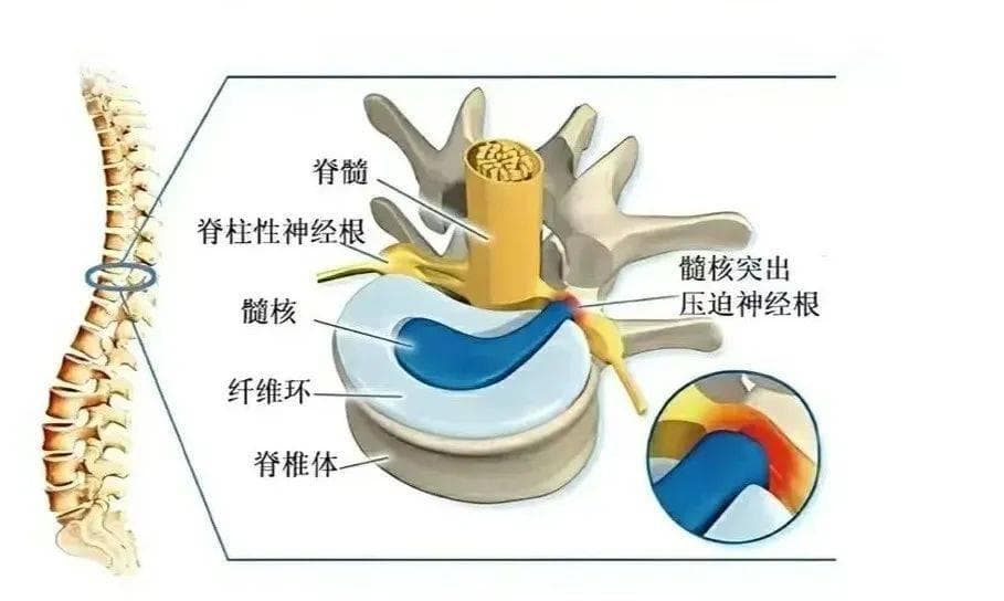 腰椎间盘突出的三个阶段（附武强颈肩腰腿保健操腰部动作）