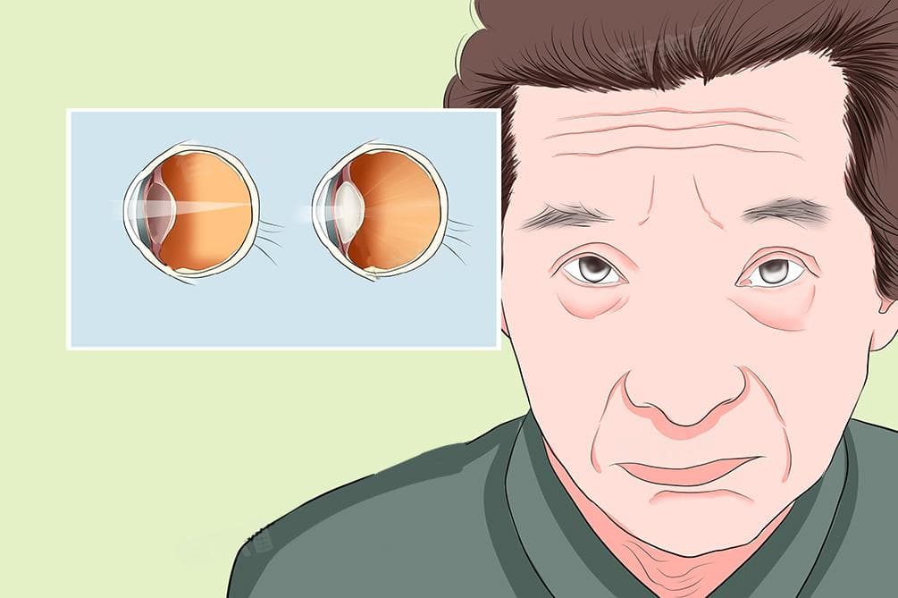 老年人眼睛看东西模糊是怎么回事