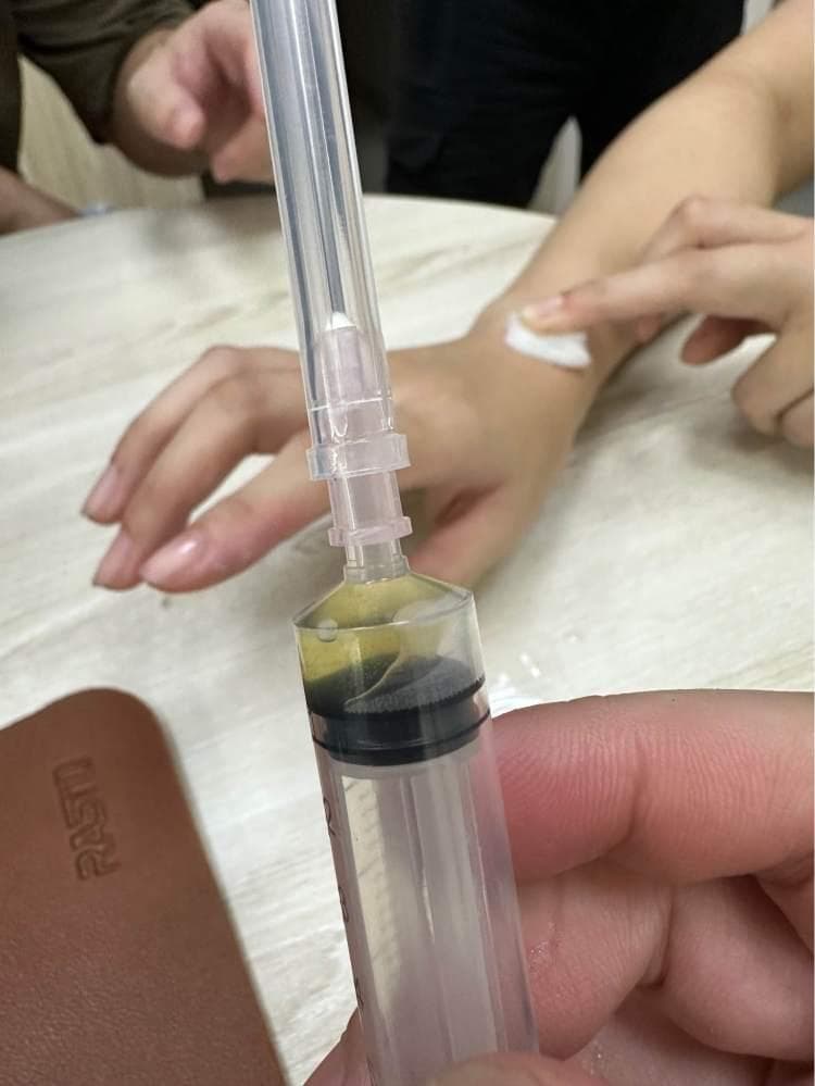 认识腱鞘囊肿及其治疗方法