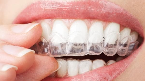 几种常见的牙齿矫正器：金属托槽、陶瓷托槽和隐形矫正器