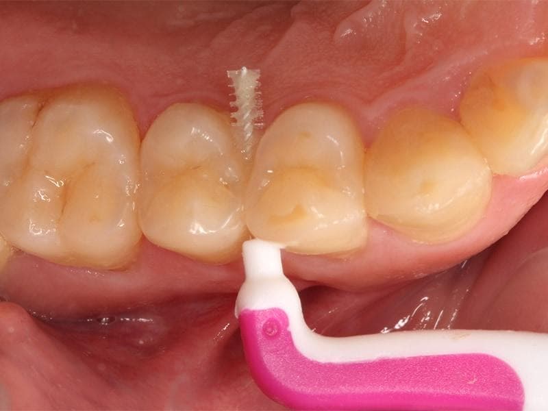 牙周病患者如何正确刷牙洗牙，5大牙齿保健工具挑选tips