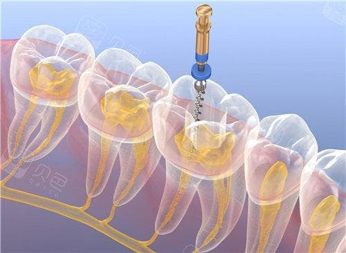 根管治疗收费标准详解：从牙齿位置到医院等级全方位解析