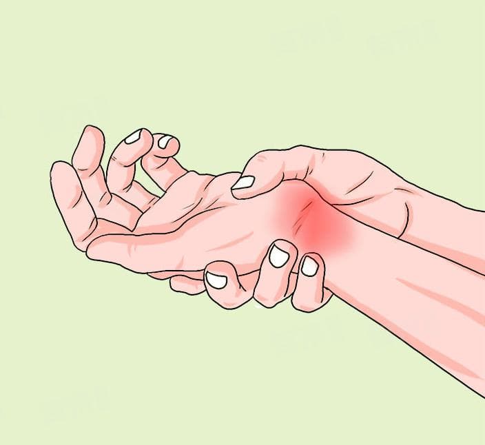 腕管综合症一招解决
