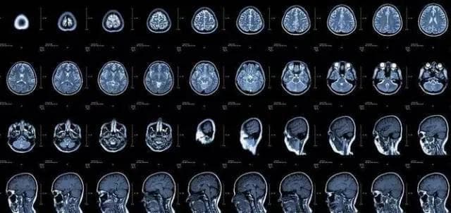 做CT还是MRI（核磁共振）？ 看完这些你就会选了！