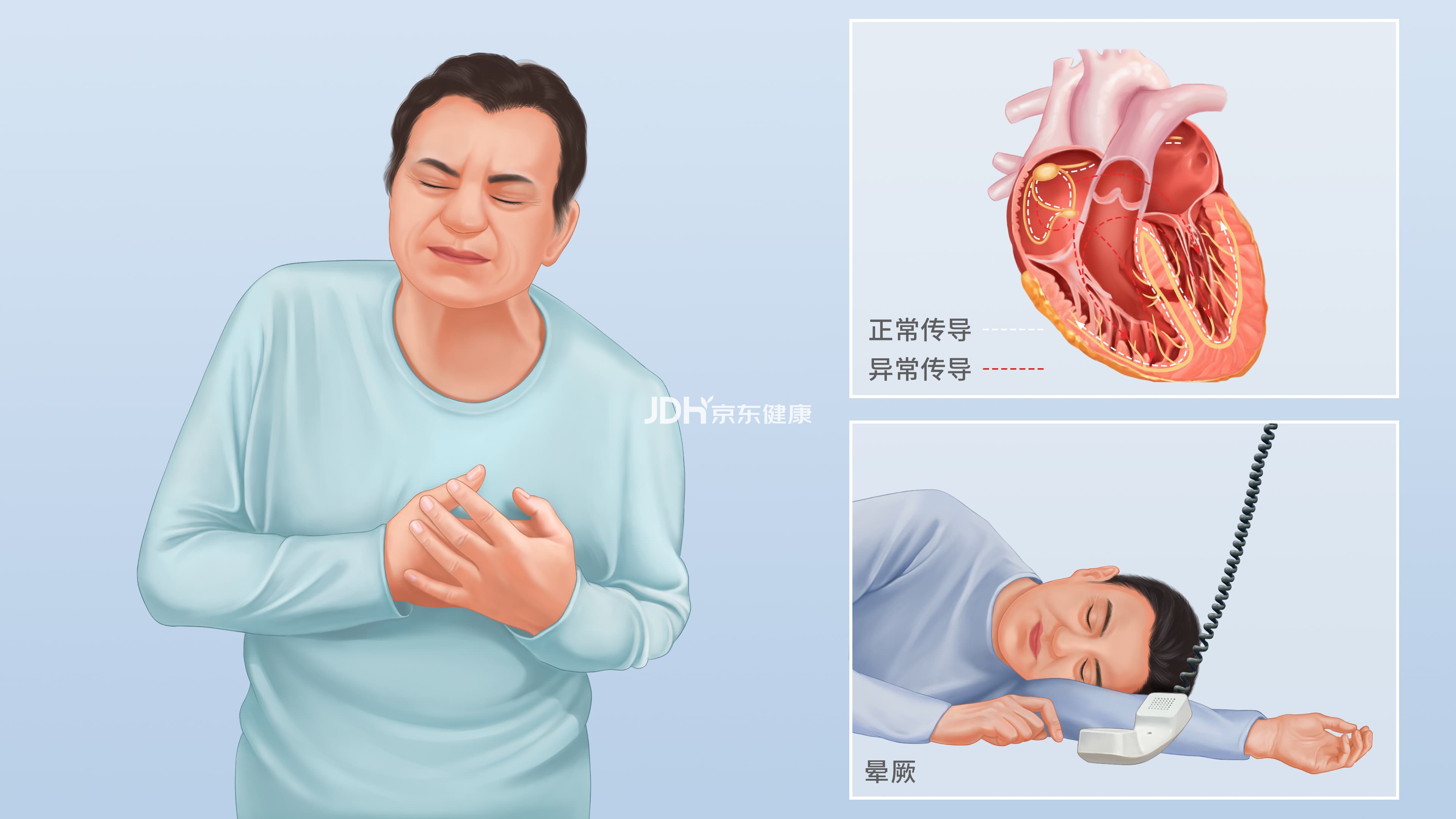 预激综合征：一种常见的心脏传导系统异常疾病