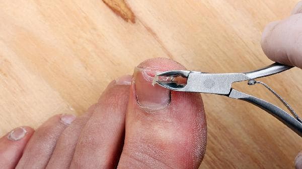 克霉唑软膏能治灰指甲吗？使用方法与注意事项全解析