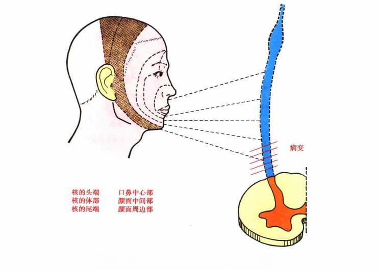 脑干病变的定位诊断图解