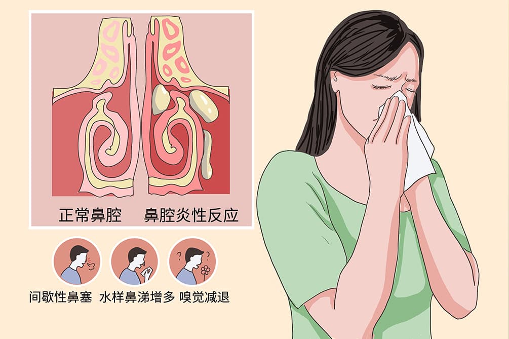 血管运动性鼻炎