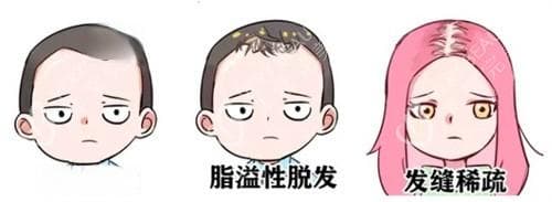 微针生发用1.5毫米治疗脱发成效好,解答微针生发多久做一次|微针生发做几次能有效