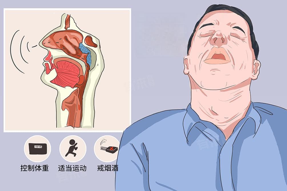 打呼噜可以治好吗