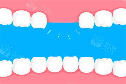 门牙做全瓷牙的过程是什么？医生解析：步骤详解+术后护理建议！