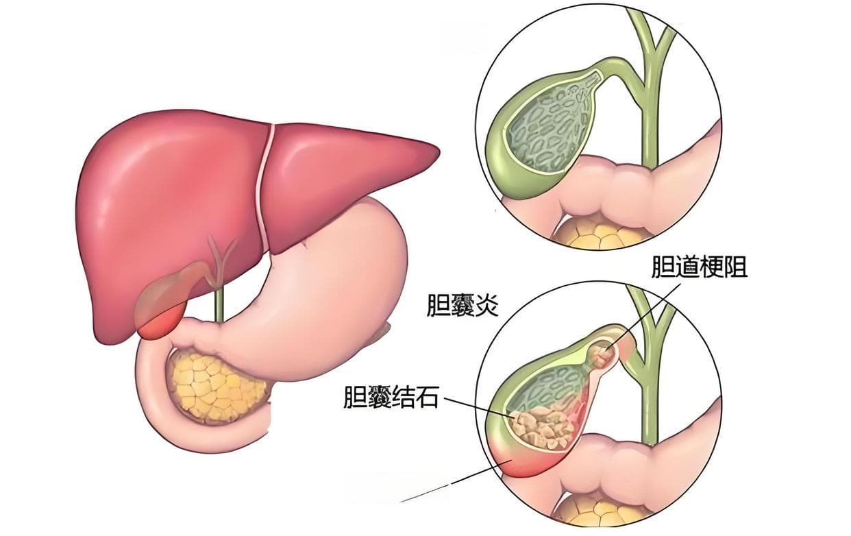 常见的胆道疾病有哪些