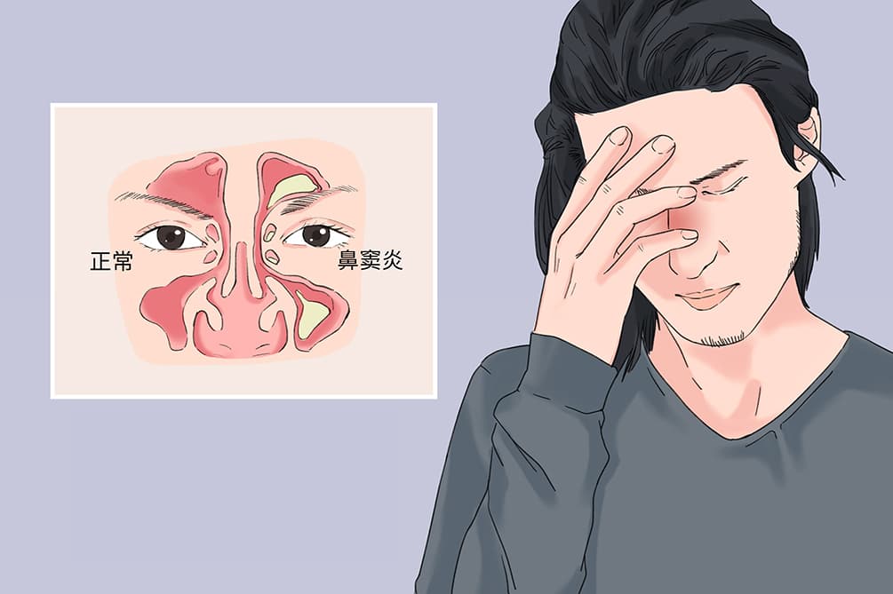 鼻窦炎穿刺：目的、作用及注意事项