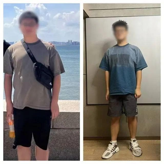 大学生减肥月瘦20斤却得了重度脂肪肝