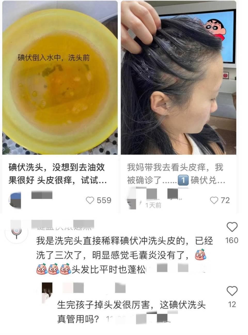 用碘伏洗发能控油、去屑？有一定杀菌作用，但不可长期使用|网红说法求真