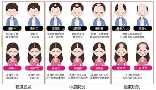 脱发治疗新选择：PDT光动力疗法安全有效