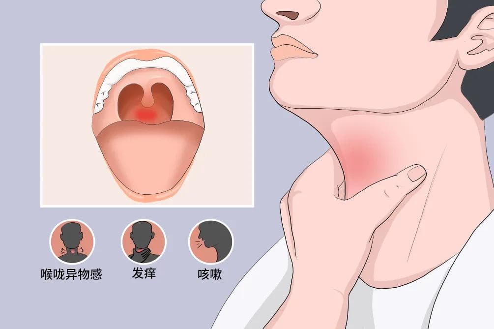 喉咙痛怎么治疗最好的方法