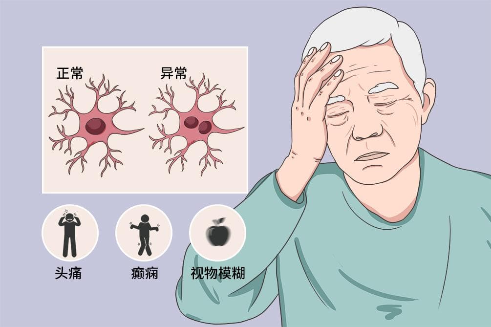 胶质瘤和脑膜瘤区别