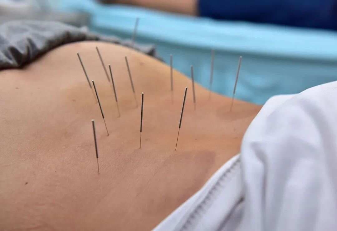 针灸治疗腰痛八法