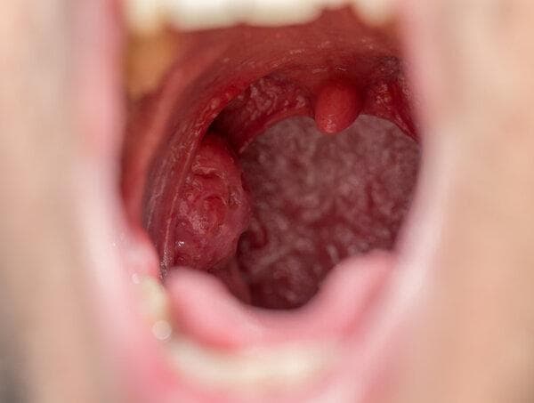 大人扁桃体肥大是什么原因造成的