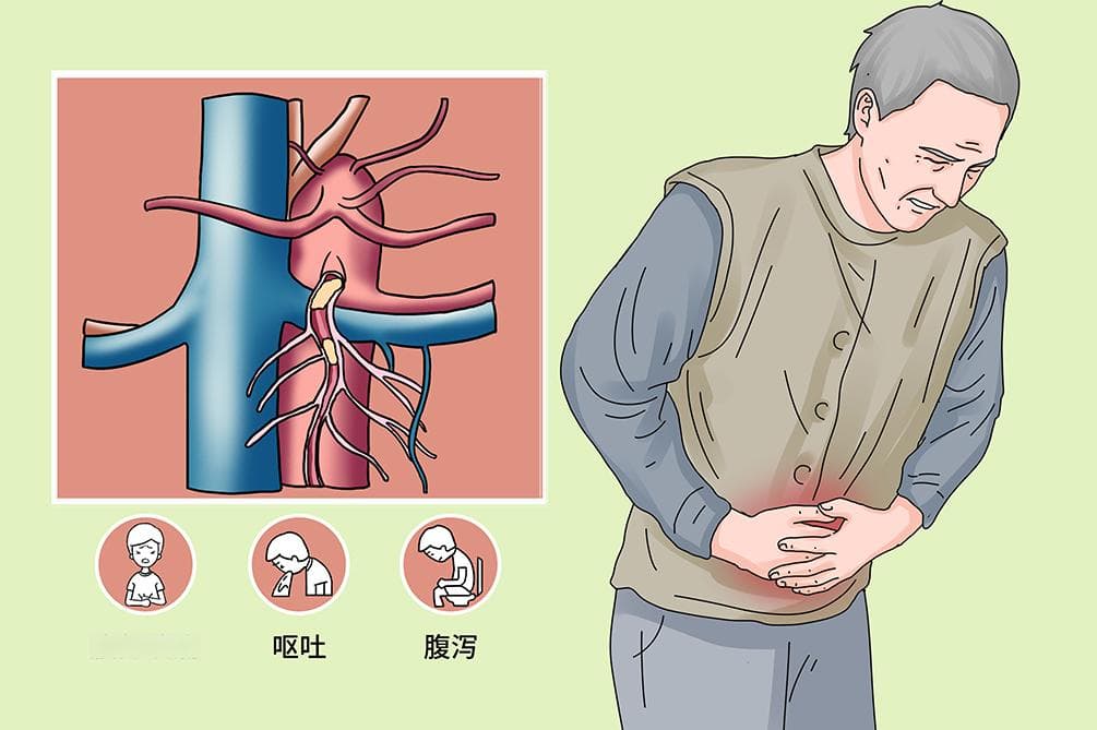 肠系膜上动脉栓塞