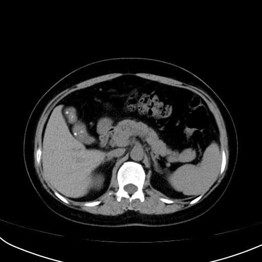 ERCP联合3D单孔腹腔镜：微创技术双剑合璧——轻松解决胆囊及胆总管结石难题