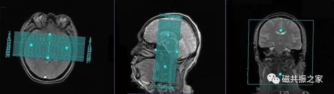 磁共振（MRI）内耳扫描技术
