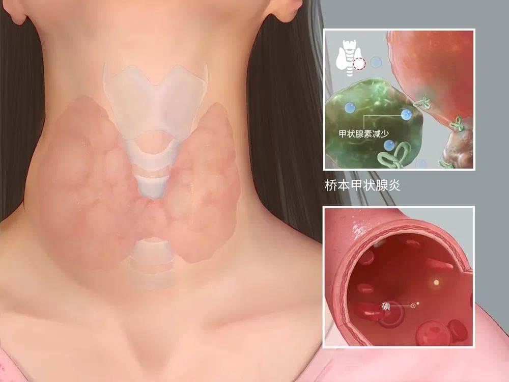 怕冷、爱犯困，情绪差？当心是得了这个经常被误诊的病