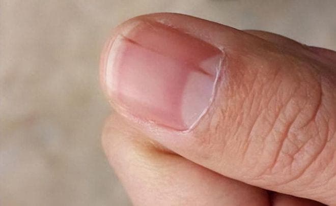 为什么指甲上会有竖纹？指甲若出现异常，或是4种问题的信号