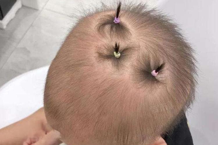 小孩子脱发严重是什么原因引起的
