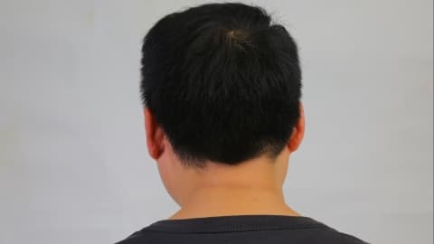 补充睡眠能改善后脑勺疼痛吗？