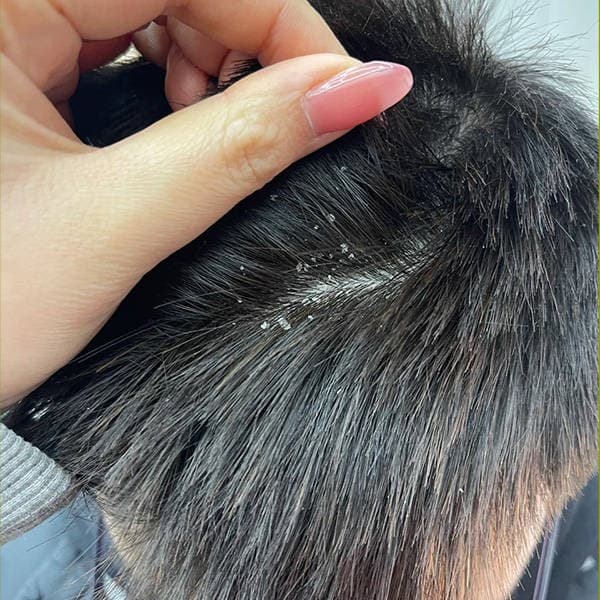 二硫化硒洗剂可以和洗发水混用吗？去屑止痒的最佳解决方案