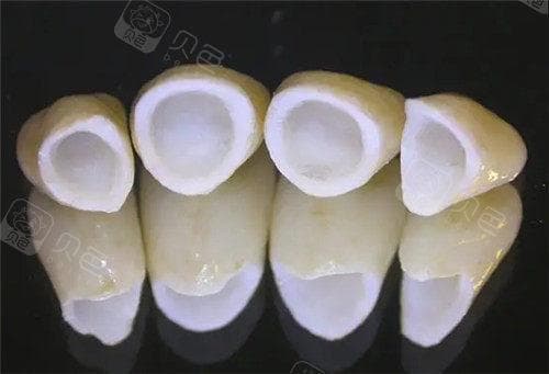 全瓷牙取下后基牙发黑？别担心，原因、处理方法及预防措施在这里！