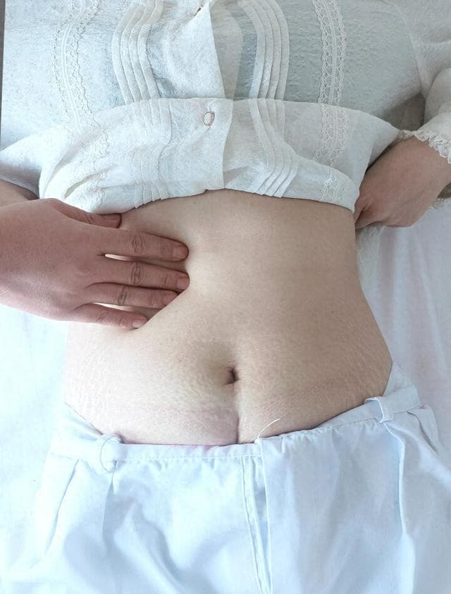 胆囊结石术后如何护理？六大要点助你快速康复