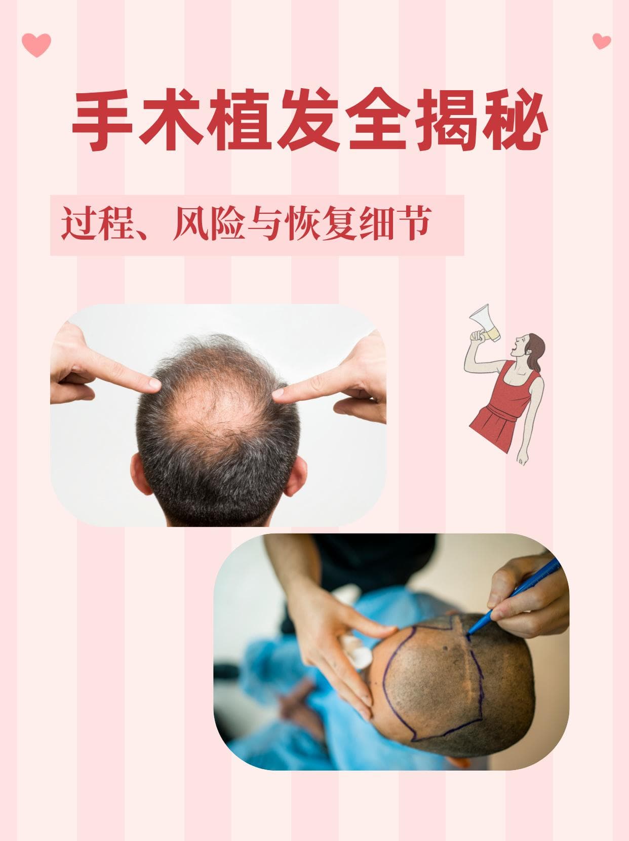手术植发全揭秘：过程、风险与恢复细节