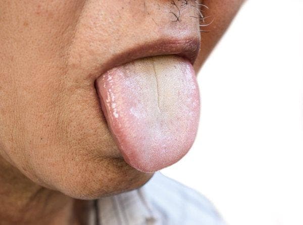 如何解决舌苔白厚、有裂缝以及大便不成形的问题
