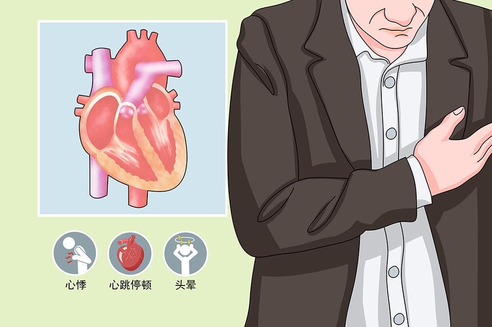 心脏早搏：成因、分类、诊断与治疗全解析