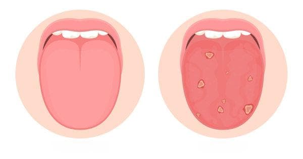 舌头溃疡、边缘有齿痕？可能是这5个原因导致