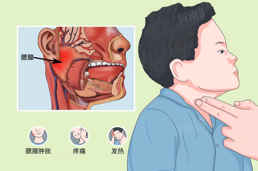 痄腮是什么？流行性腮腺炎的病因、症状与预防措施