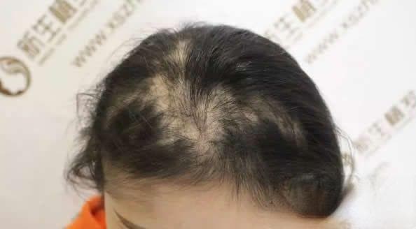 原来引起脱发的原因是这样的 那你属于M型还是O型脱发呢