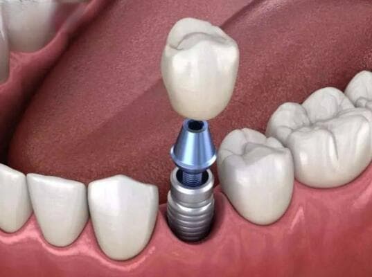 掉牙后多久去种牙比较好?这几方面因素决定了多久能完成种植