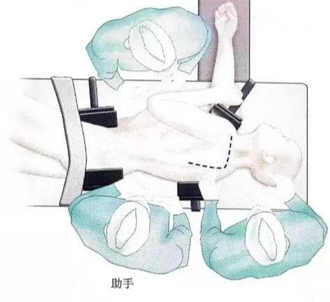 肩盂骨折诊疗方案详解：从手术指征到术后护理
