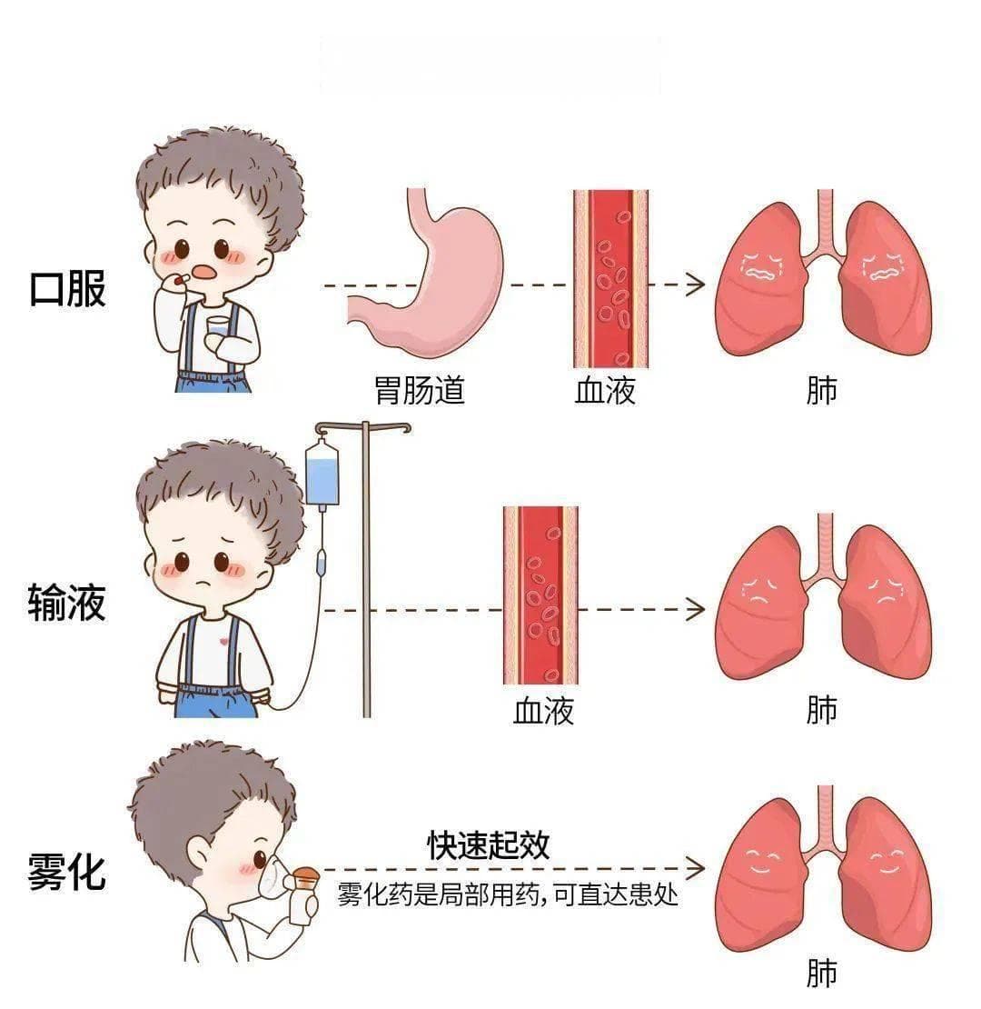 雾化吸入为什么有时布地奈德联合特布他林，而有时加异丙托溴胺？